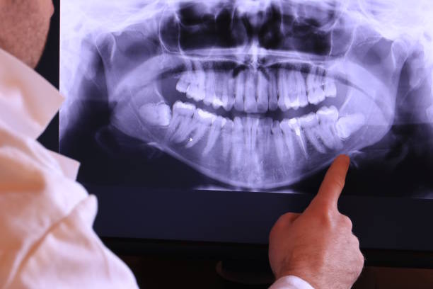 Best Emergency Treatment for Dental Infections or Abscesses in Cornwall, PA