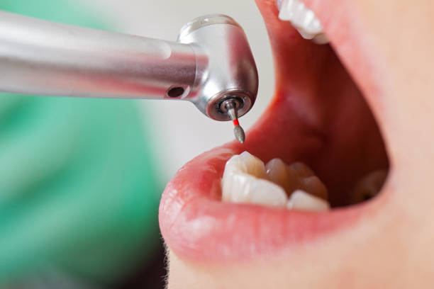 Best Emergency Wisdom Teeth Removal in Cornwall, PA